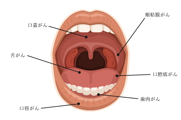 口腔がんの種類