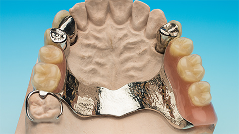 金属床　部分入れ歯（チタン床・コバルト床）