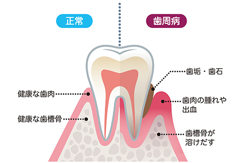 歯周病とは