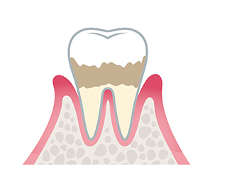 軽度歯周炎