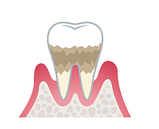 中度歯周炎