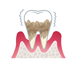 重度歯周炎