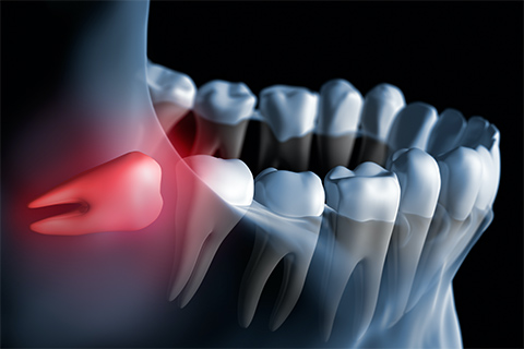 親知らずの抜歯治療とは