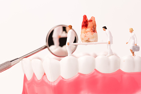 歯牙移植